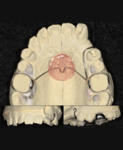 西端歯科医院 埋伏犬歯牽引用ナンスホールディングアーチ