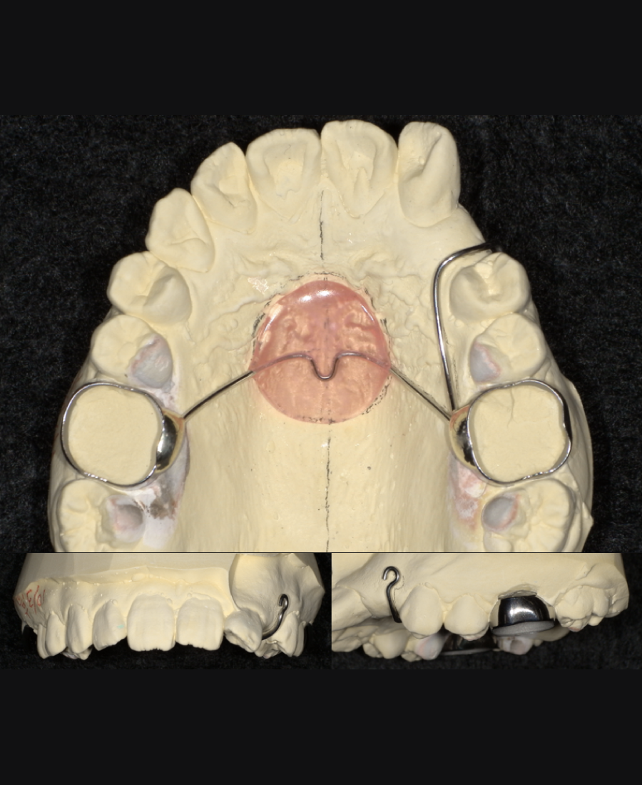 西端歯科医院 埋伏犬歯牽引用ナンスホールディングアーチ