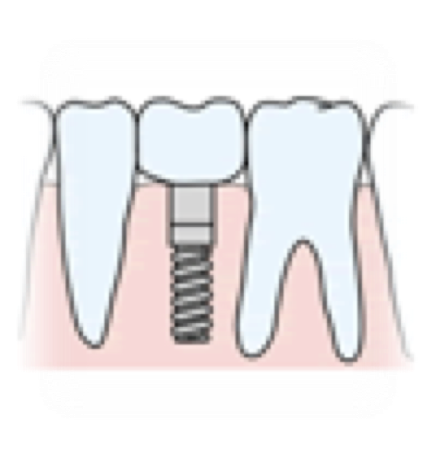 インプラント